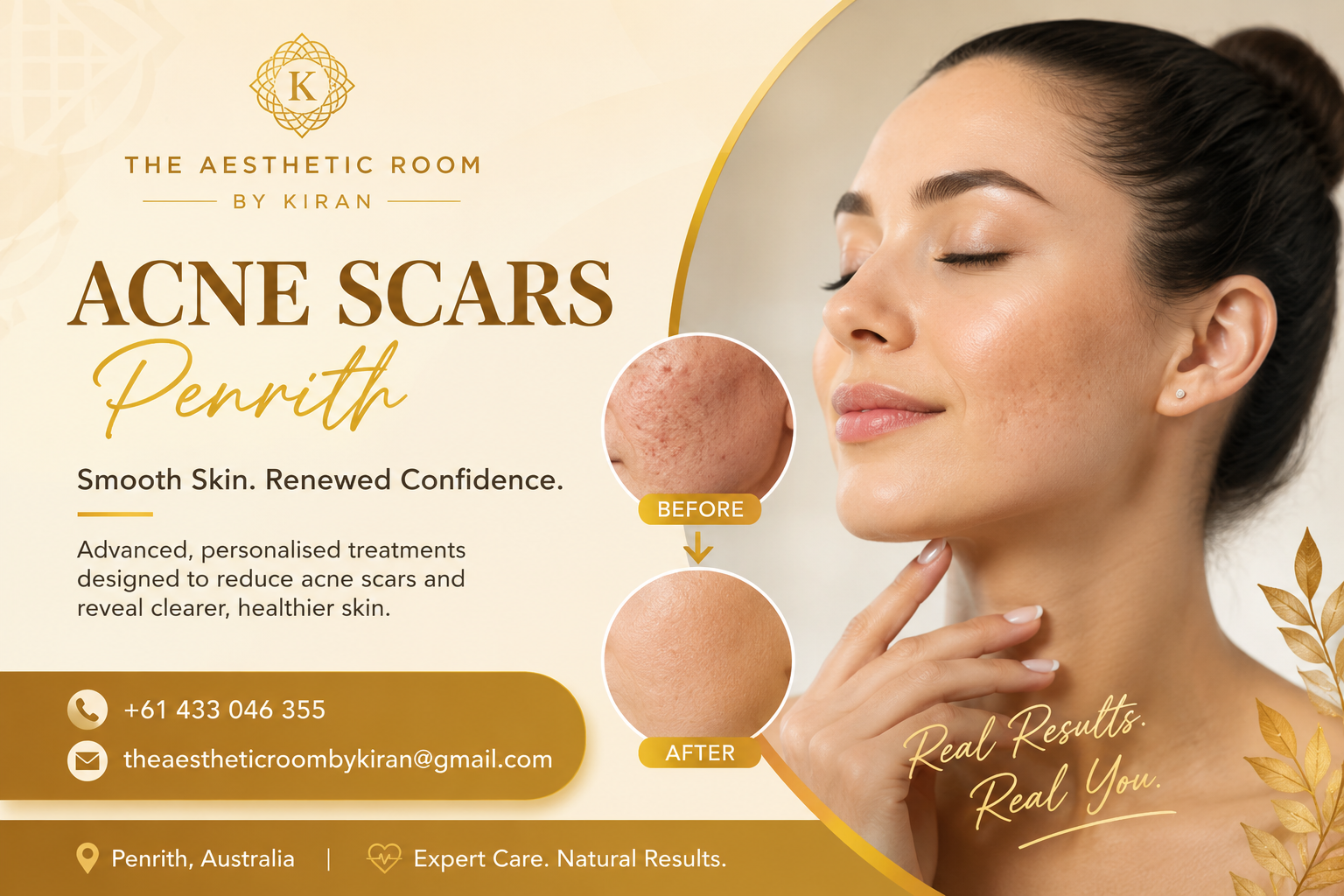 Acne Scars Treatment Penrith Australia using Microneedling PRP and PRF at The Aesthetic Room by Kiran