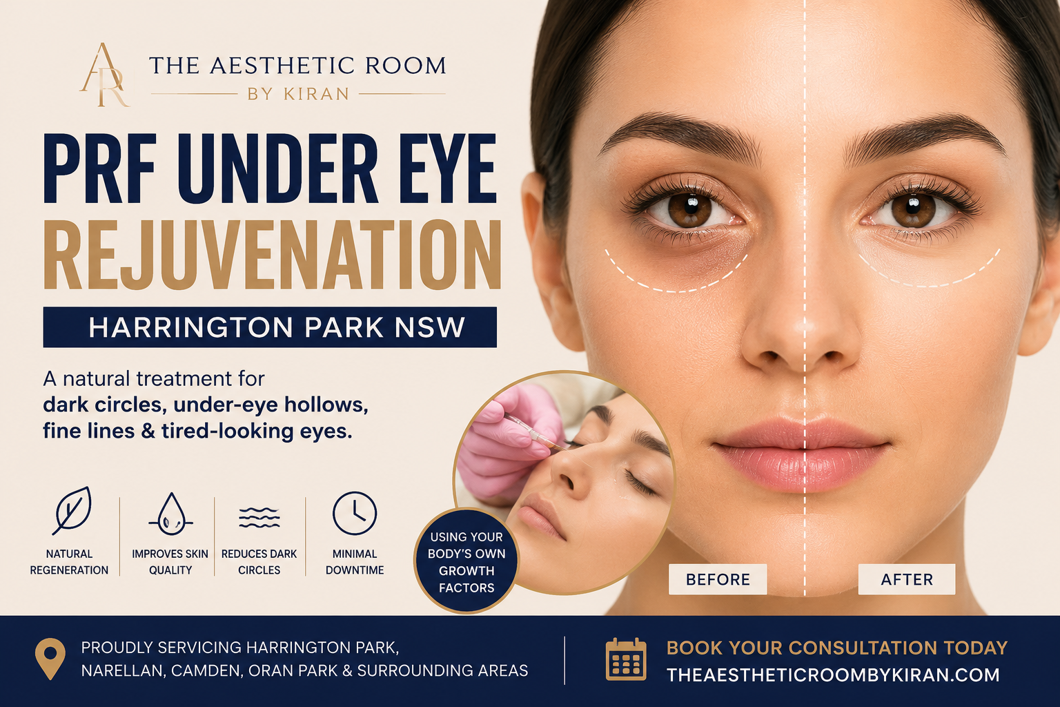 PRF Eye Treatment Harrington Park NSW for dark circles and eye rejuvenation