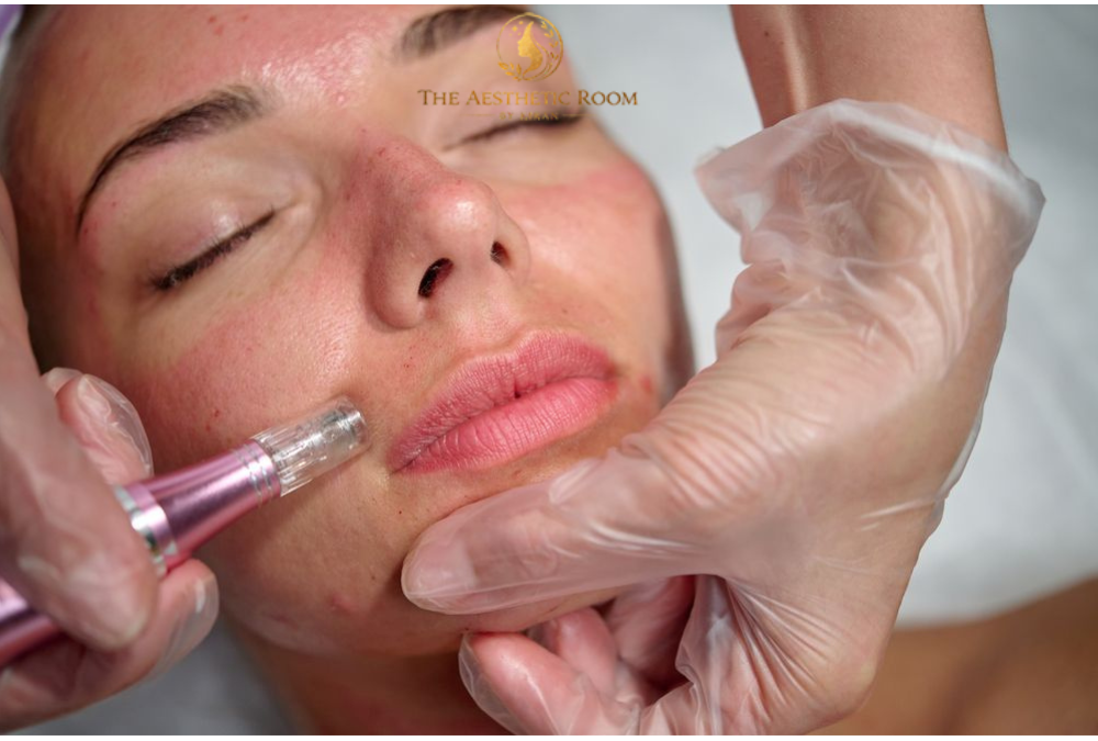 PRP with microneedling treatment at The Aesthetic Room by Kiran in Narellan