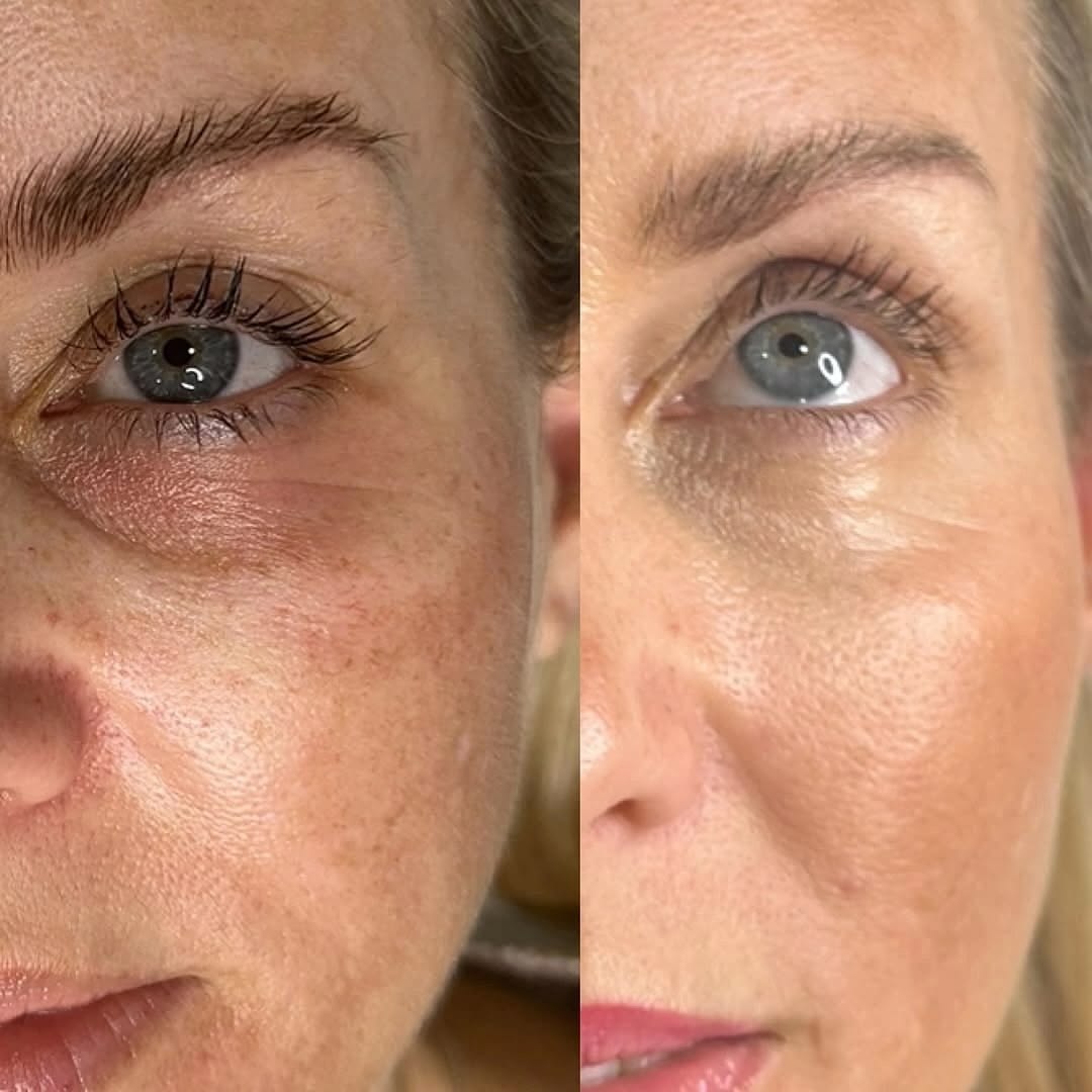 PRP – Full Face Rejuvenation in Leppington Australia