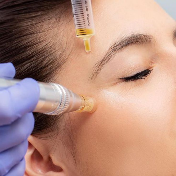PRP + Skin Needling Combination in MacArthur Australia