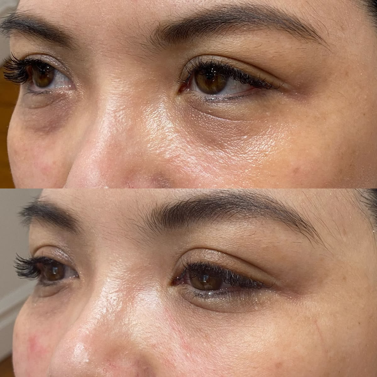 PRF Under Eye Rejuvenation in Leppington NSW Australia