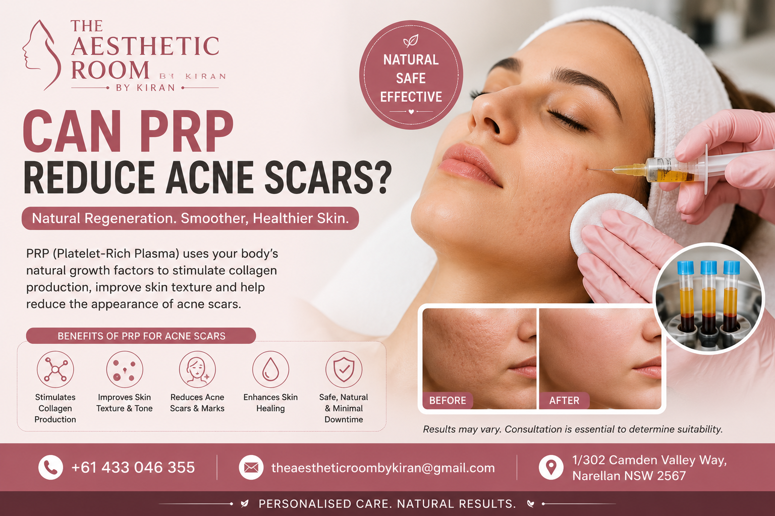 Can PRP reduce acne scars with platelet-rich plasma and microneedling treatment in Narellan