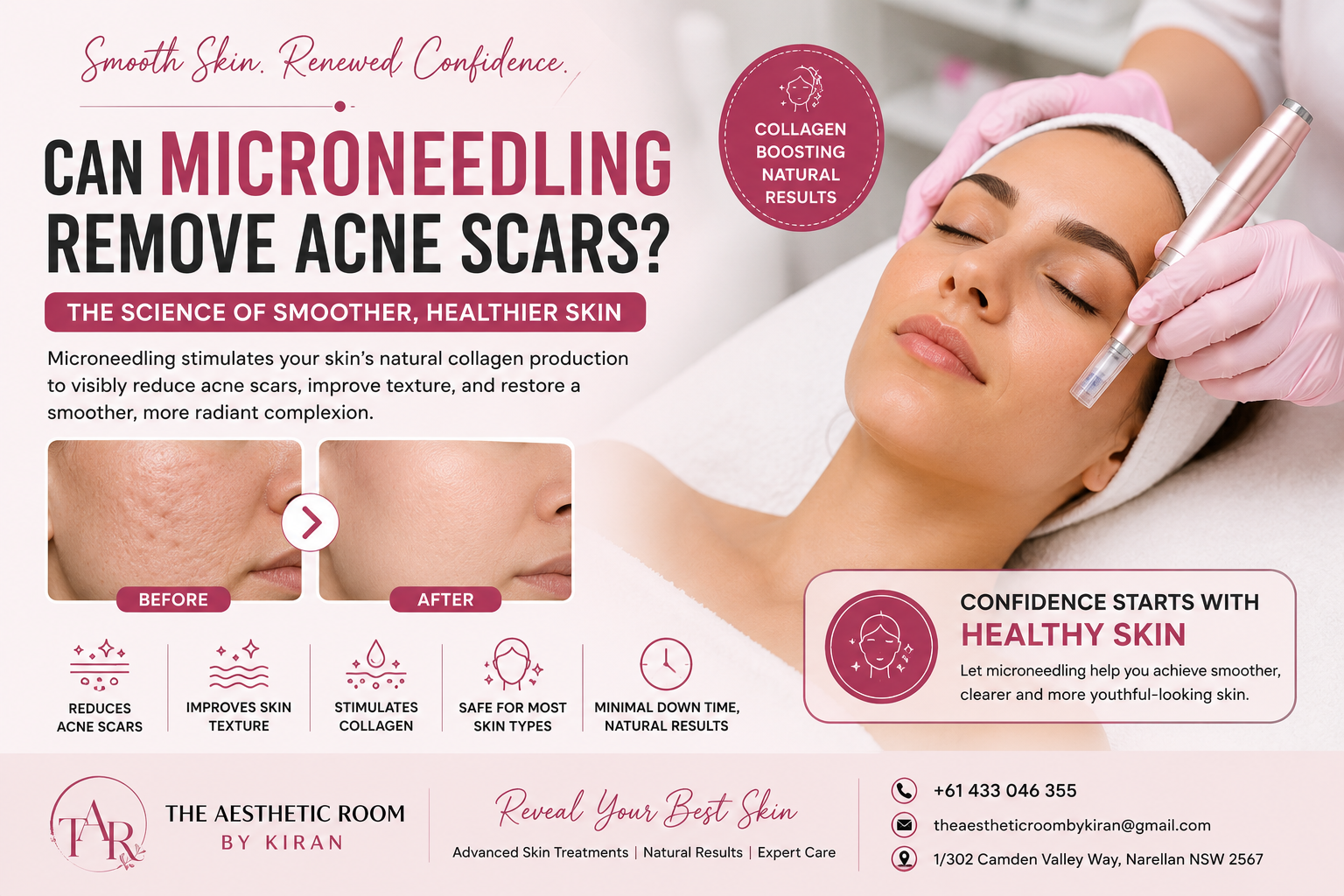 Professional microneedling treatment for acne scars showing smoother skin, collagen stimulation, acne scar reduction, skin rejuvenation, and glowing complexion at The Aesthetic Room by Kiran in Narellan NSW