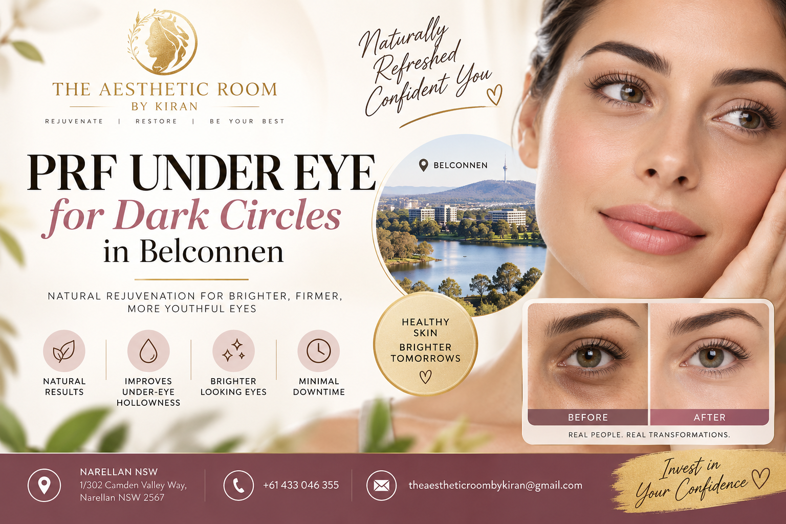 PRF Under Eye for Dark Circles in Belconnen