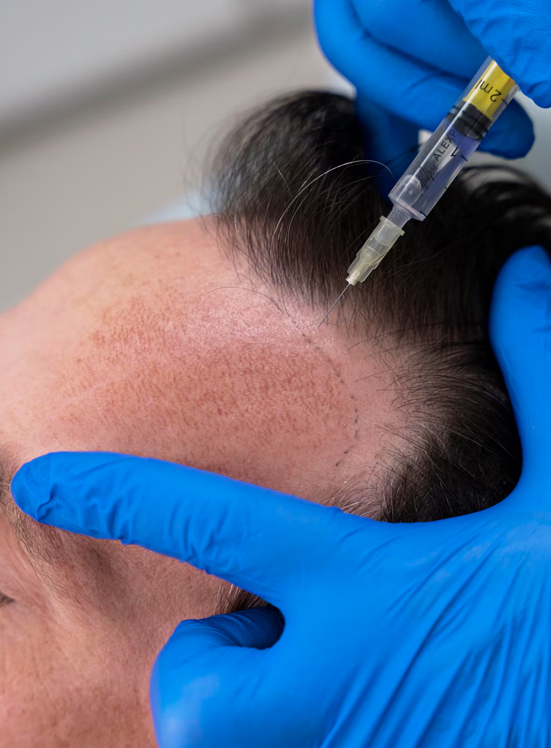 Acne marks in narellan nsw